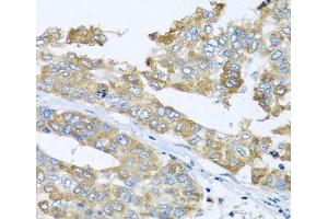 Immunohistochemistry of paraffin-embedded Human liver cancer using COQ7 Polyclonal Antibody at dilution of 1:100 (40x lens). (Coq7 anticorps)