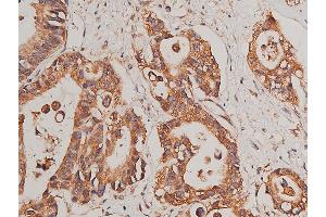 ABIN6268758 at 1/50 staining human colon cancer tissue sections by IHC-P. (CYP17A1 anticorps  (Internal Region))