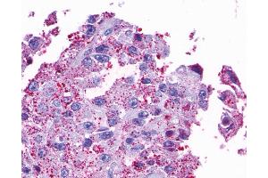 Anti-OPN5 antibody IHC of human Ovary, Carcinoma.