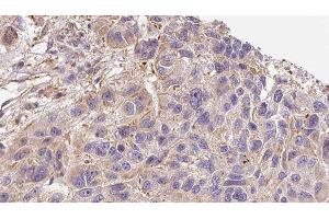 ABIN6276397 at 1/100 staining Human Melanoma tissue by IHC-P. (Interleukin 17a anticorps  (Internal Region))