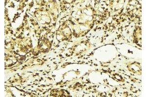 ABIN6267569 at 1/100 staining Human breast cancer tissue by IHC-P. (PRKDC anticorps  (pThr2647))