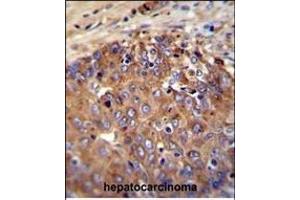 NOS2A Antibody (Center) (ABIN655717 and ABIN2845167) immunohistochemistry analysis in formalin fixed and paraffin embedded human hepatocarcinoma followed by peroxidase conjugation of the secondary antibody and DAB staining.