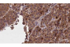 ABIN6277234 at 1/100 staining Human liver cancer tissue by IHC-P. (GNAO1 anticorps  (Internal Region))