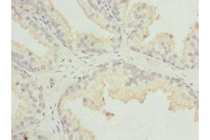 Immunohistochemistry of paraffin-embedded human prostate cancer using ABIN7158931 at dilution of 1:100 (MR1 anticorps  (AA 20-260))