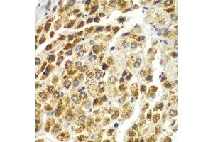 Immunohistochemistry of paraffin-embedded human liver cancer using SND1 antibody.