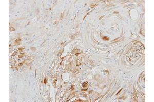 IHC-P Image Immunohistochemical analysis of paraffin-embedded Ca922 xenograft, using BCAT2, antibody at 1:500 dilution.