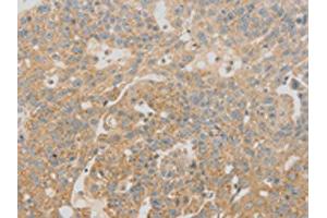 The image on the left is immunohistochemistry of paraffin-embedded Human breast cancer tissue using ABIN7130971(SCAP Antibody) at dilution 1/20, on the right is treated with fusion protein.