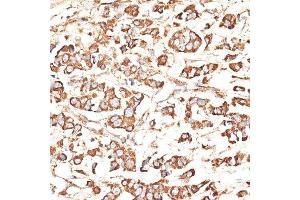 Immunohistochemistry of paraffin-embedded human mammary cancer using KIR3DS1 antibody. (KIR3DS1 anticorps  (AA 80-340))
