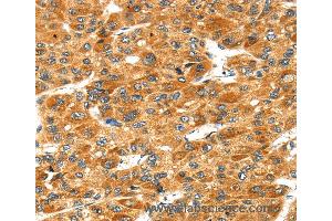 Immunohistochemistry of Human liver cancer using STXBP4 Polyclonal Antibody at dilution of 1:40 (STXBP4 anticorps)