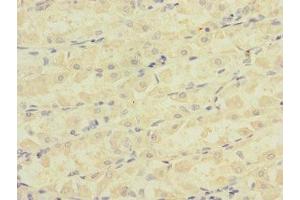 Immunohistochemistry of paraffin-embedded human gastric cancer using ABIN7145065 at dilution of 1:100