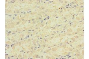 Immunohistochemistry of paraffin-embedded human gastric cancer using ABIN7145065 at dilution of 1:100 (Attractin anticorps  (AA 84-350))