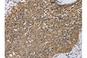 The image on the left is immunohistochemistry of paraffin-embedded Human cervical cancer tissue using ABIN7130557(PCP4 Antibody) at dilution 1/50, on the right is treated with fusion protein. (PCP4 anticorps)