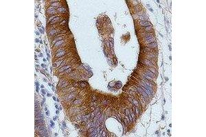 Immunohistochemical analysis of Alpha-tubulin staining in human colon cancer formalin fixed paraffin embedded tissue section.