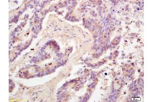 Formalin-fixed and paraffin embedded human colon carcinoma labeled with Rabbit Anti Adiponectin Polyclonal Antibody, Unconjugated (ABIN669051) at 1:200 followed by conjugation to the secondary antibody and DAB staining (ADIPOQ anticorps  (AA 151-244))
