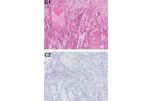 Immunohistochemical analysis of PDCD4 shows the corresponding H&E-stained and PDCD4-stained tissue sections from patients with OSCC.