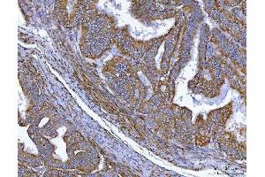 IHC analysis of MIM/MTSS1 using anti-MIM/MTSS1 antibody (ABIN7600276). (MTSS1 anticorps  (AA 17-692))