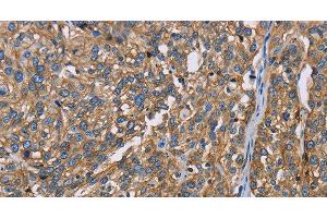 Immunohistochemistry of paraffin-embedded Human esophagus cancer using BSG Polyclonal Antibody at dilution of 1:60 (CD147 anticorps)