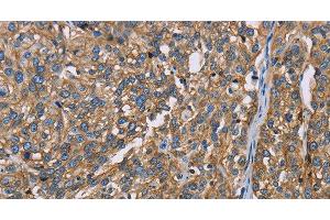 Immunohistochemistry of paraffin-embedded Human esophagus cancer using BSG Polyclonal Antibody at dilution of 1:60 (CD147 anticorps)