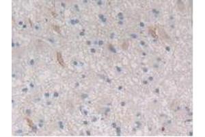 IHC-P analysis of Human Glioma Tissue, with DAB staining. (CTRB1 anticorps  (AA 34-261))