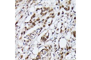 Immunohistochemistry of paraffin-embedded human colon carcinoma using hnRNPM antibody (ABIN6128031, ABIN6141919, ABIN6141920 and ABIN6222681) at dilution of 1:100 (40x lens).