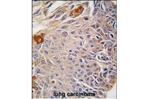 Formalin-fixed and paraffin-embedded human lung carcinoma reacted with RMND5B antibody (C-term), which was peroxidase-conjugated to the secondary antibody, followed by DAB staining. (RMND5B anticorps  (C-Term))