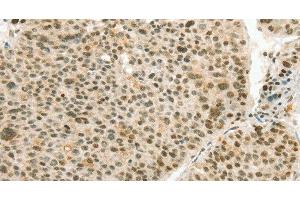 Immunohistochemistry of paraffin-embedded Human liver cancer using ANGPT4 Polyclonal Antibody at dilution of 1:70 (Angiopoietin 4 anticorps)