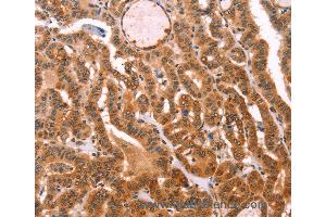 Immunohistochemistry of Human lung cancer using PROS1 Polyclonal Antibody at dilution of 1:40 (PROS1 anticorps)