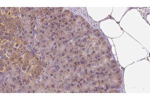 ABIN6273260 at 1/100 staining Human pancreas cancer tissue by IHC-P. (LAPTM4B anticorps  (Internal Region))