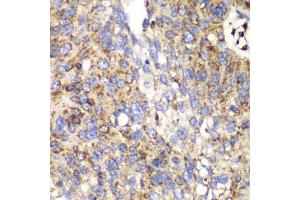 Immunohistochemistry of paraffin-embedded human lung cancer using SPARC antibody (ABIN3022250, ABIN3022251, ABIN1513555 and ABIN6218694) at dilution of 1:100 (40x lens). (SPARC anticorps  (AA 18-303))