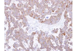 IHC-P Image Immunohistochemical analysis of paraffin-embedded OVCAR3 xenograft, using TCP-1 theta , antibody at 1:500 dilution.