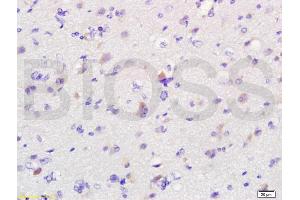 Formalin-fixed and paraffin embedded human glioma labeled with Anti-MIF Polyclonal Antibody, Unconjugated (ABIN736836) at 1:200 followed by conjugation to the secondary antibody and DAB staining.