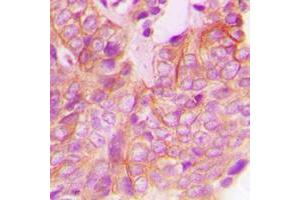 Immunohistochemical analysis of FRK staining in human breast cancer formalin fixed paraffin embedded tissue section. (FRK anticorps  (Center))
