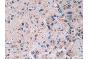 Detection of ATXN10 in Human Prostate cancer Tissue using Polyclonal Antibody to Ataxin 10 (ATXN10)