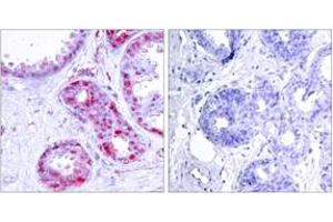 Immunohistochemistry analysis of paraffin-embedded human breast carcinoma, using c-Jun (Phospho-Ser243) Antibody.