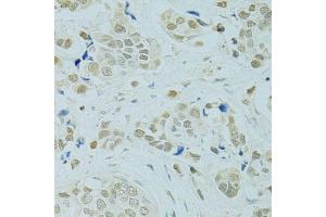Immunohistochemistry of paraffin-embedded human breast cancer using RCC1 antibody (ABIN5973761) at dilution of 1/100 (40x lens). (RCC1 anticorps)