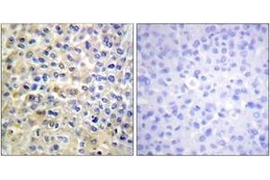 Immunohistochemistry analysis of paraffin-embedded human breast carcinoma tissue, using EGFR (Ab-678) Antibody. (EGFR anticorps  (AA 651-700))