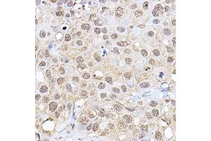 Immunohistochemistry of paraffin-embedded human breast cancer using p70 S6 Kinase 1 1 Rabbit pAb (ABIN3023168, ABIN3023169, ABIN3023170, ABIN1513490 and ABIN6219422) at dilution of 1:100 (40x lens).