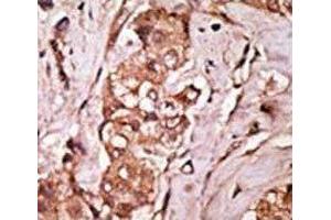 IHC analysis of FFPE human breast carcinoma tissue stained with the LRRK2 antibody