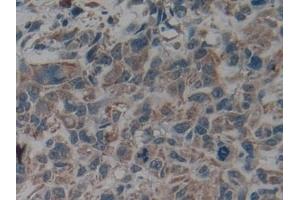 Detection of CK9 in Human Lung cancer Tissue using Polyclonal Antibody to Cytokeratin 9 (CK9)