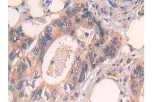 Detection of CPR in Human Colorectal cancer Tissue using Polyclonal Antibody to Cytochrome P450 Reductase (CPR)