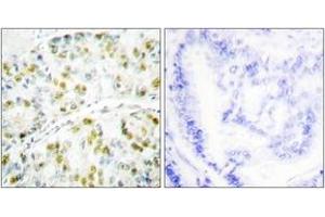 Immunohistochemistry analysis of paraffin-embedded human lung carcinoma tissue, using Ataxin 1 (Ab-776) Antibody.