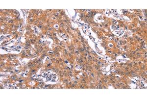 Immunohistochemistry of paraffin-embedded Human gastic cancer using CD269 Polyclonal Antibody at dilution of 1:30 (BCMA anticorps)