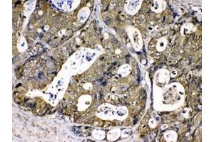IHC testing of FFPE human intestinal cancer tissue with Cyclophilin A antibody at 1ug/ml. (PPIA anticorps)