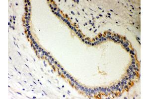 Anti- Unrip Picoband antibody, IHC(P) IHC(P): Human Mammary Cancer Tissue