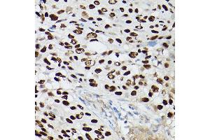 Immunohistochemistry of paraffin-embedded human lung squamous carcinoma tissue using p63 Rabbit mAb (ABIN7271099) at dilution of 1:100 (40x lens). (p63 anticorps)