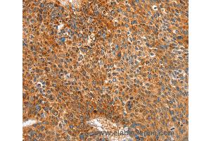 Immunohistochemistry of Human colon cancer using ALDH1A2 Polyclonal Antibody at dilution of 1:30 (ALDH1A2 anticorps)