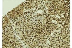 ABIN6278743 at 1/100 staining Human breast cancer tissue by IHC-P. (SART3 anticorps  (C-Term))
