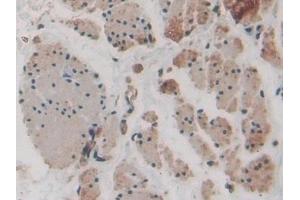 Detection of FOXO1 in Human Esophagus cancer Tissue using Polyclonal Antibody to Forkhead Box Protein O1 (FOXO1)