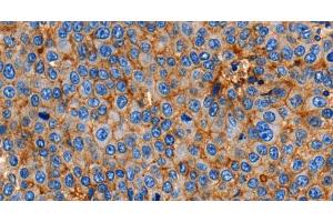 Immunohistochemistry of paraffin-embedded Human esophagus cancer using Claudin 1 Polyclonal Antibody at dilution of 1:150 (Claudin 1 anticorps)