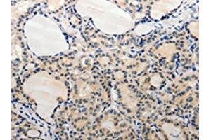 The image on the left is immunohistochemistry of paraffin-embedded Human thyroid cancer tissue using ABIN7189663(ADAMTS6 Antibody) at dilution 1/20, on the right is treated with synthetic peptide. (ADAMTS6 anticorps)